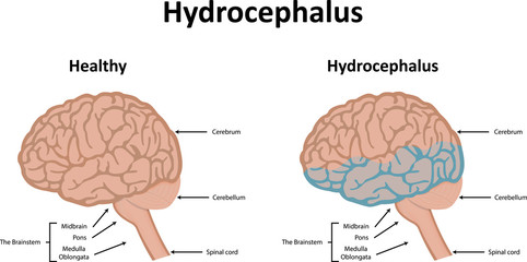 Hydrocephalus Illustration