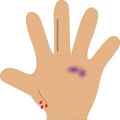 Hand Injury Illustration