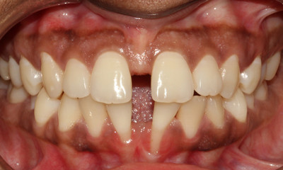 Fototapeta premium Gap Between Teeth