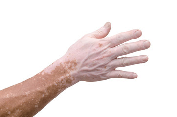 Man's hand with with vitiligo on white background