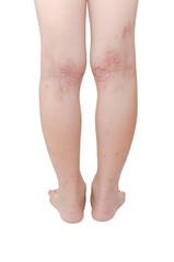 Legs with sore from scratching of a boy over white background