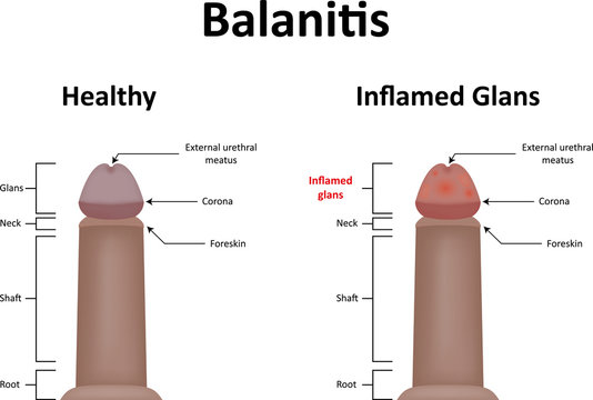 Balanitis Illustration