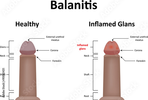 Rimedi di gente per cura di eczema di mani