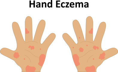 Hand Eczema