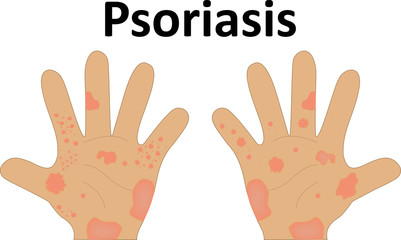 Psoriasis Illustration