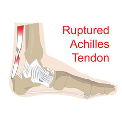 vector illustration of achilles tendon rupture