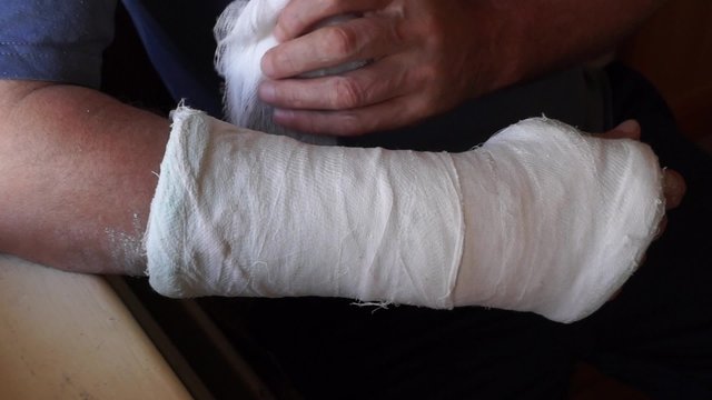 A man removes plaster from healed hand in dark room
