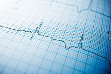 Electrocardiogram