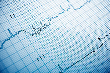 Electrocardiogram