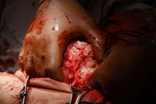 Surgeon's hand on the tumor