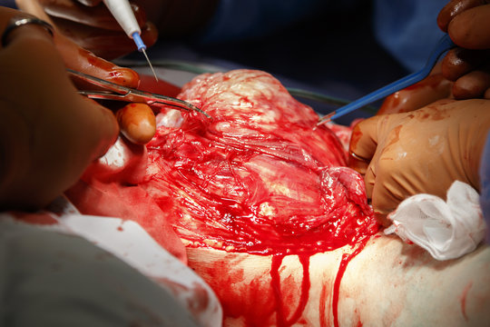 Removal Of The Tumor