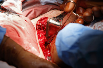 Surgeon's finger inside the wound