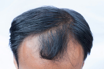 bald head of young man on  white background