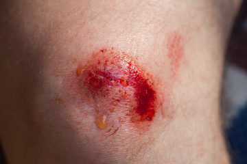 Broken bleeding knee - deep scratches on the skin with bruises and wet tracks