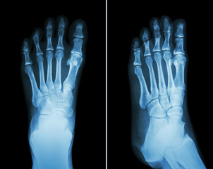 Film x-ray both foot ( 2 position : front view and side view )
