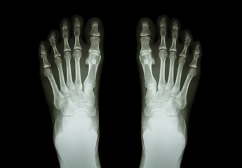 Film x-ray both foot ( front view )