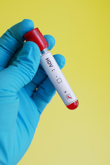 Fototapeta premium Hepatitis D virus (HDV) positive