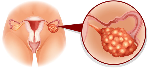 Overian cancer diagram in detail