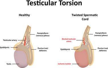 Testicular Torsion Illustration - obrazy, fototapety, plakaty