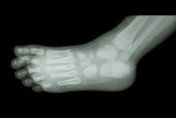 film x-ray of child 's foot ( side view ) ( lateral )