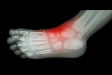 Arthritis and injury at ankle  :  film x-ray of child 's foot ( side view ) ( lateral )