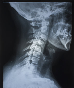 radio graphs skull and cervical vertebra