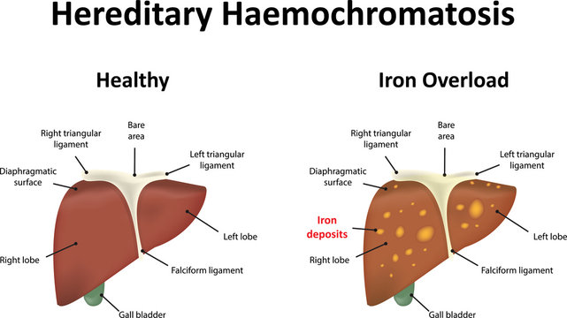 Hereditary Haemochromatosis