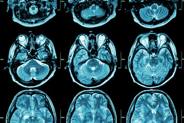 MRI of Brain ( cross section of brain ) ( Medical , Health care , Science background )