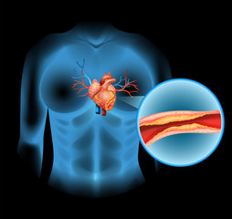 Heart disease caused by cholesteral