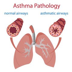 vector illustration of lungs and airways. Normal and asthmatic.
