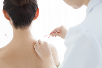 Acupuncturists are pierced acupuncture to women's shoulder