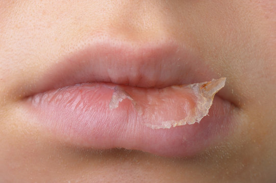 Hautablösung an Lippe durch Xerotisches Ekzem frontal Stock-Foto | Adobe  Stock