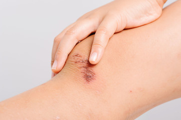 Wound on child knee from accident become dry