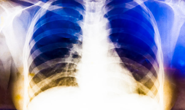 X-ray Image Of Human Chest