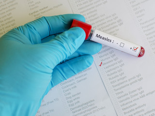 Measles positive - obrazy, fototapety, plakaty