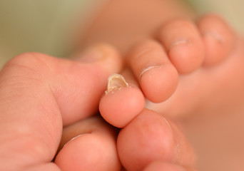 toenail fungus © muro