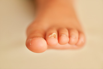 toenail fungus