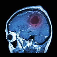 Film MRI of brain with brain tumor ( Sagittal plane , side view , lateral view ) ( Medical , Health...