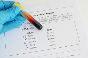 Blood sample with result of hepatitis B virus profile testing