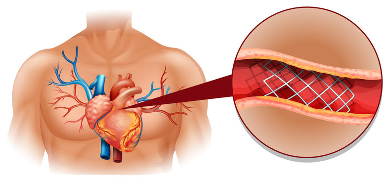 Heart disease diagram in human