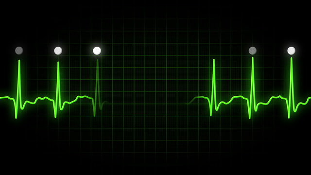 EKG Monitor Screen