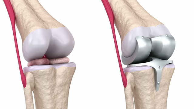 Knee and titanium hinge joint. Isolated on white