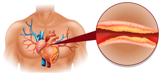 Cholesterol in human heart