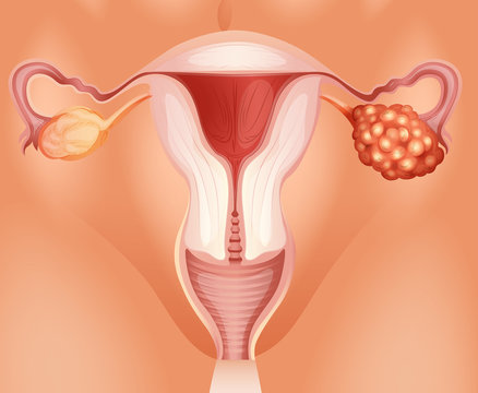 Ovarian Cancer In Woman