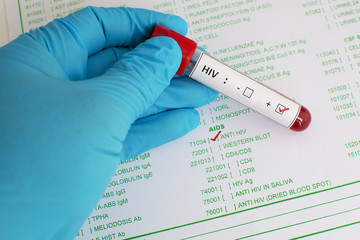 Blood sample with HIV positive