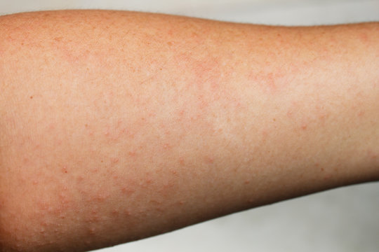 Human skin, presenting an allergic reaction.