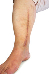 Fototapeta na wymiar Human leg with postoperative scar of cardiac surgery
