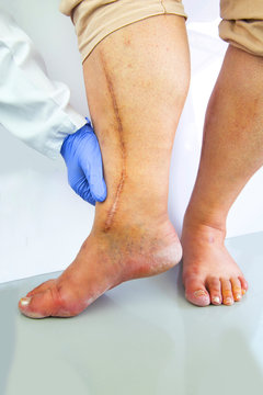 Human leg with postoperative scar of cardiac surgery