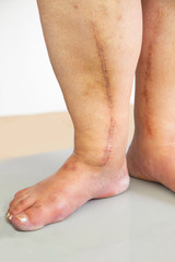 Human leg with postoperative scar of cardiac surgery