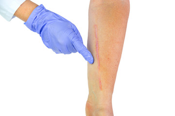 Human arm with postoperative scar of cardiac surgery